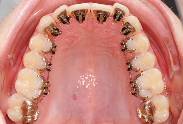 ارتودنسی پشت دندان